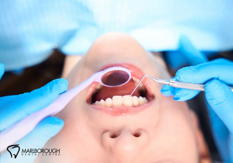 3 Tips for Choosing the Right Type of Dental Filling in Calgary